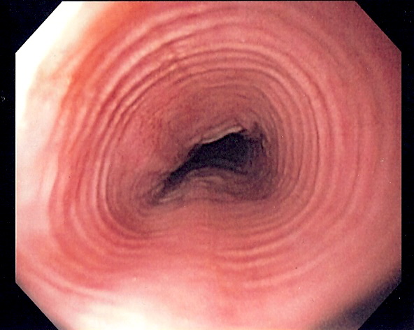 Eosinophile Ösophagitis
Trachealisierung des Ösophagus
